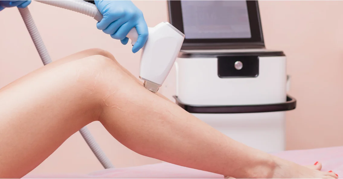 épilation laser à Briare près de Gien dans le Loiret 45